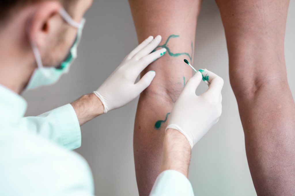 Minimally invasive VenaSeal vein treatment explained by Albany Surgical, showing varicose vein closure, improved circulation, and modern vein care options.